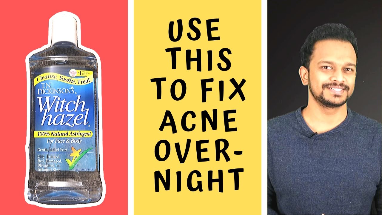 HOW TO GET RID OF ACNE & ACNE SCARS FAST | Skincare Routine, Using Witch Hazel to Remove Acne