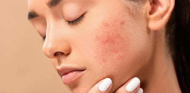 The Retinol Side Effects